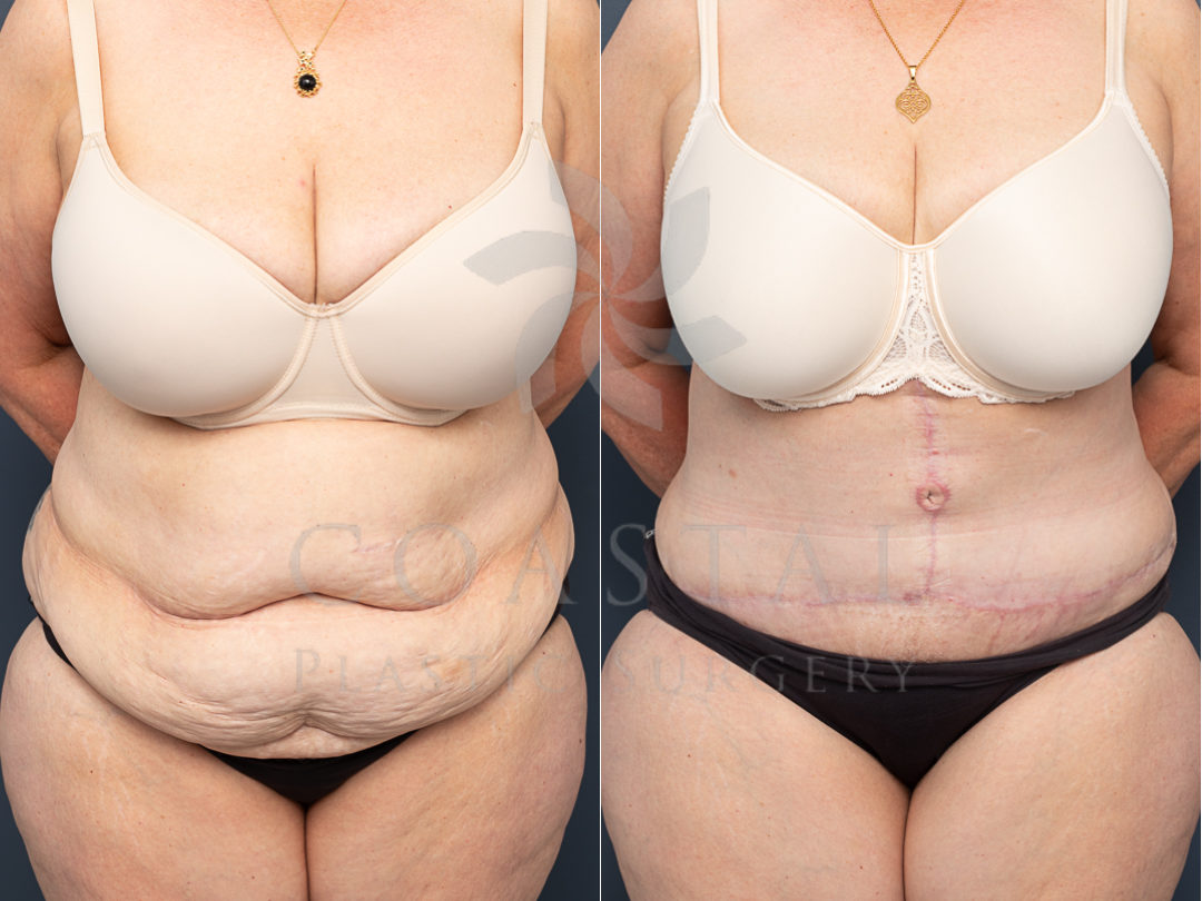 LH extended abdominoplasty front