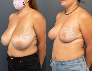 breast reduction