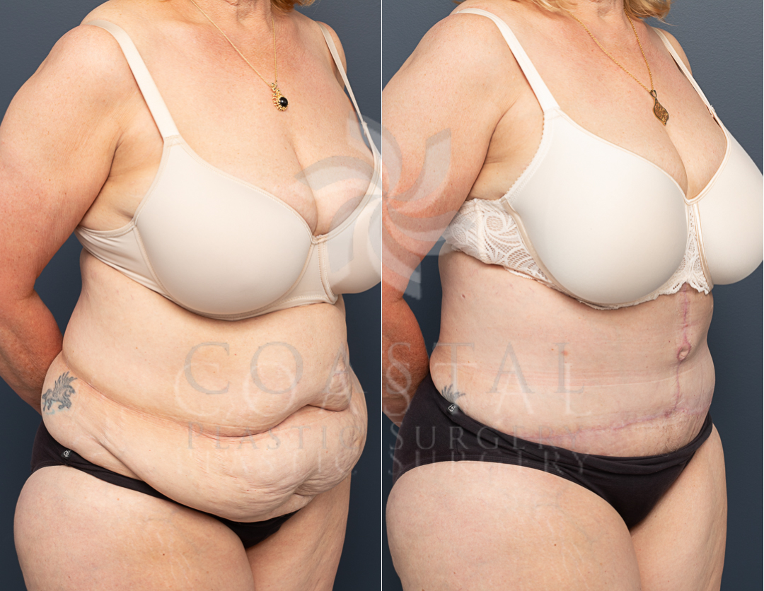 abdominoplasty