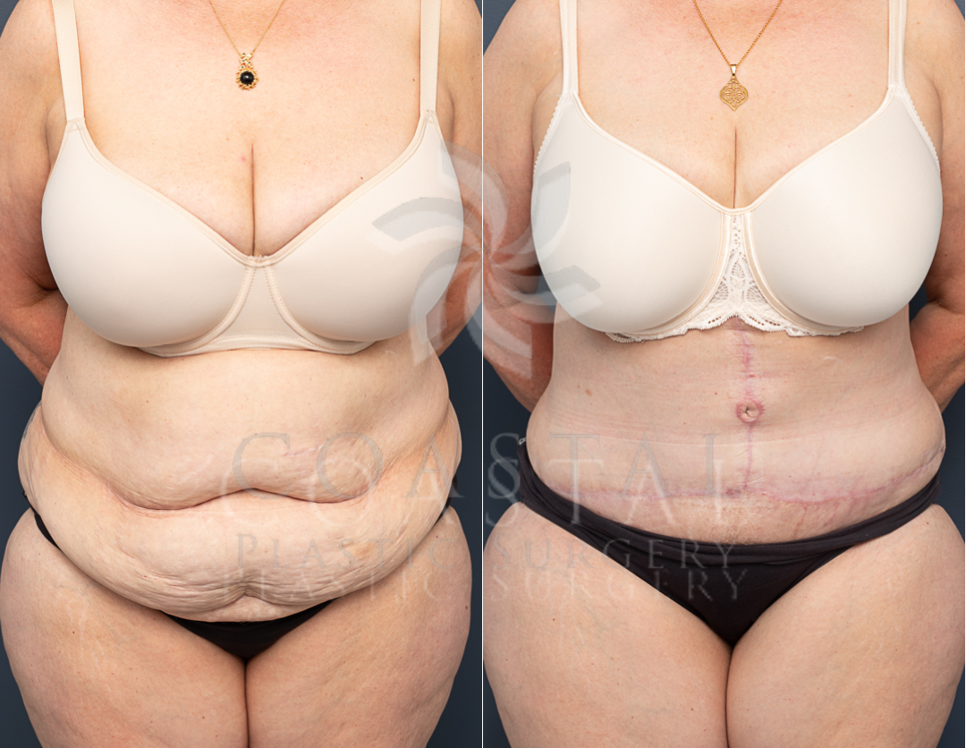 abdominoplasty