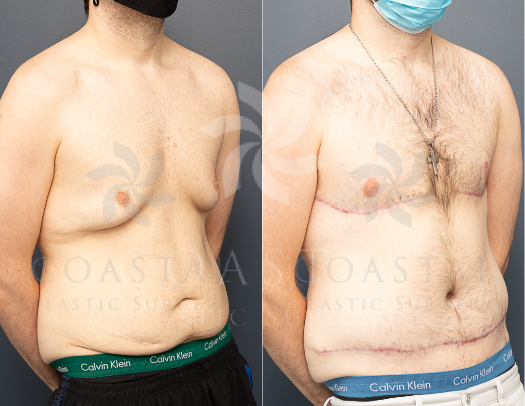 gynaecomastia