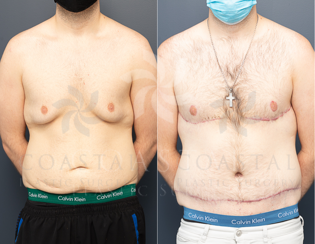 gynaecomastia