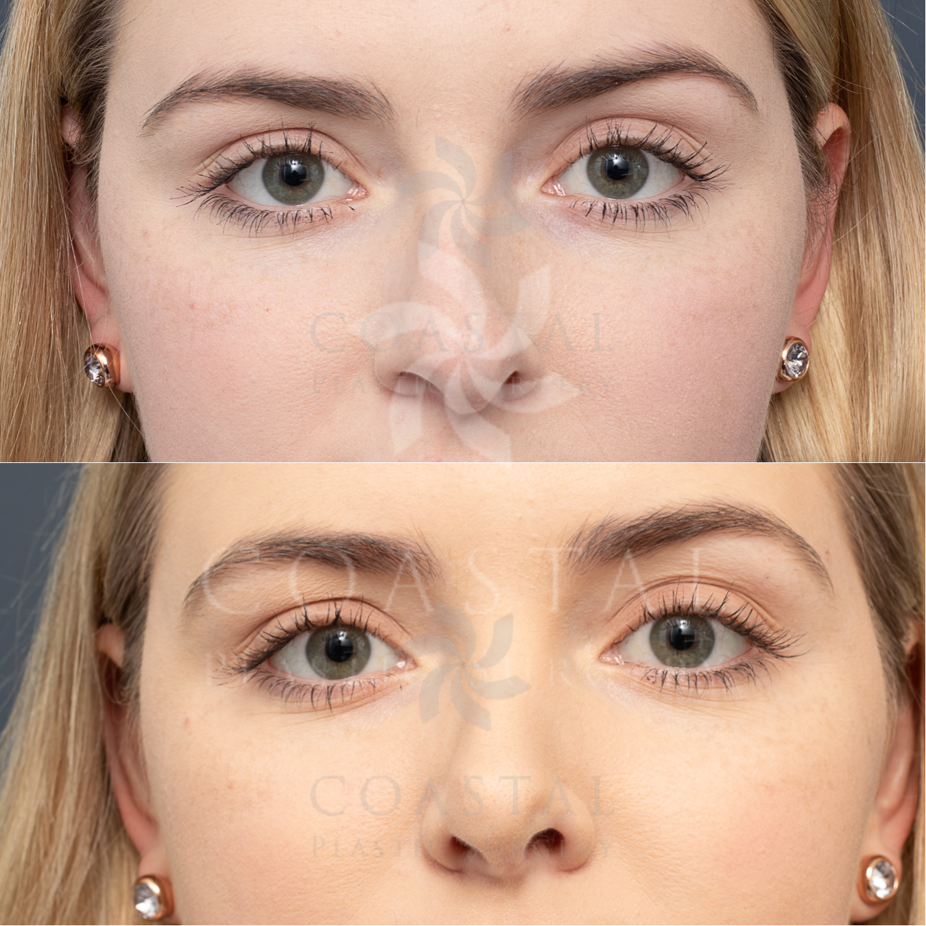 rhinoplasty