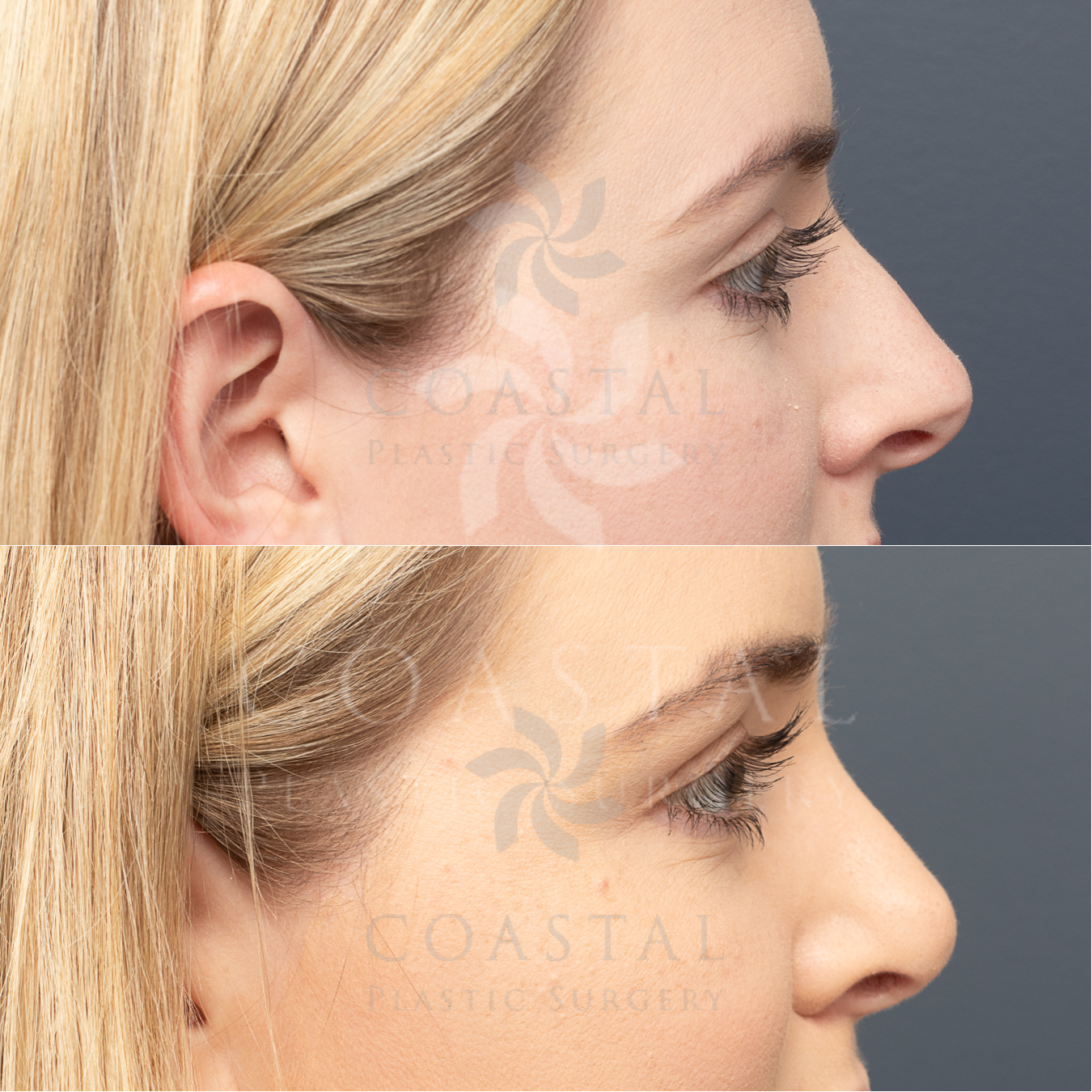 rhinoplasty