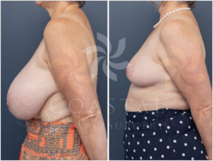 breast reduction