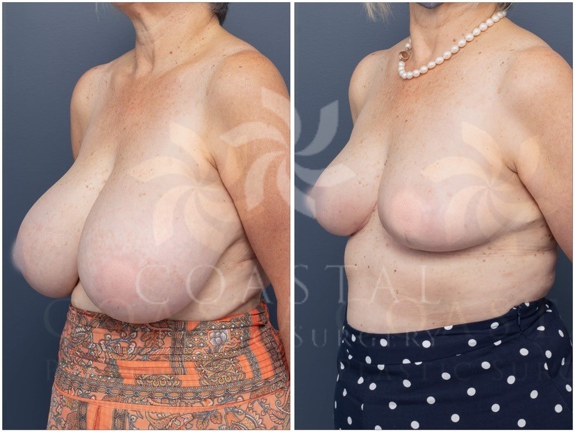 breast reduction