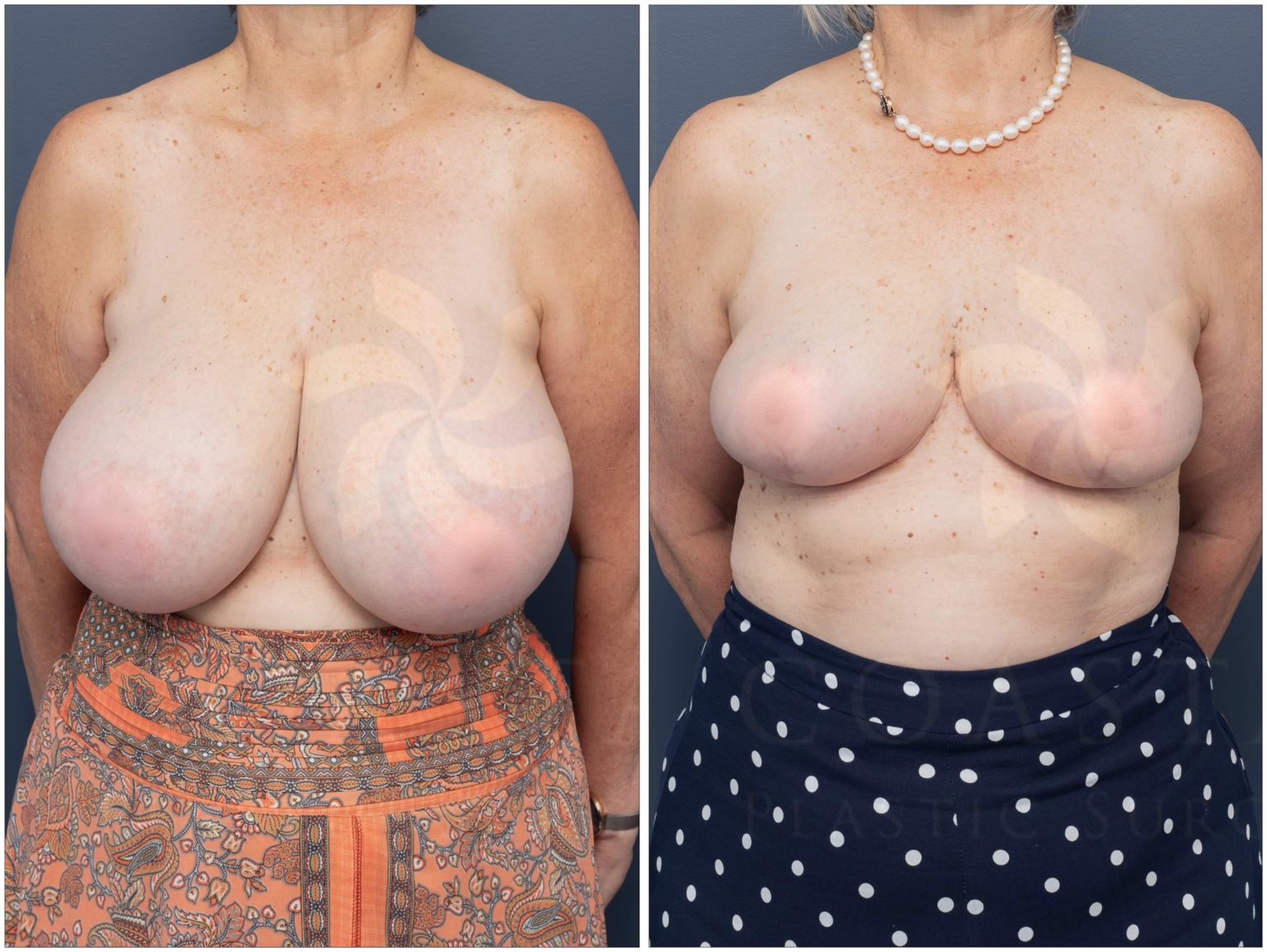 breast reduction