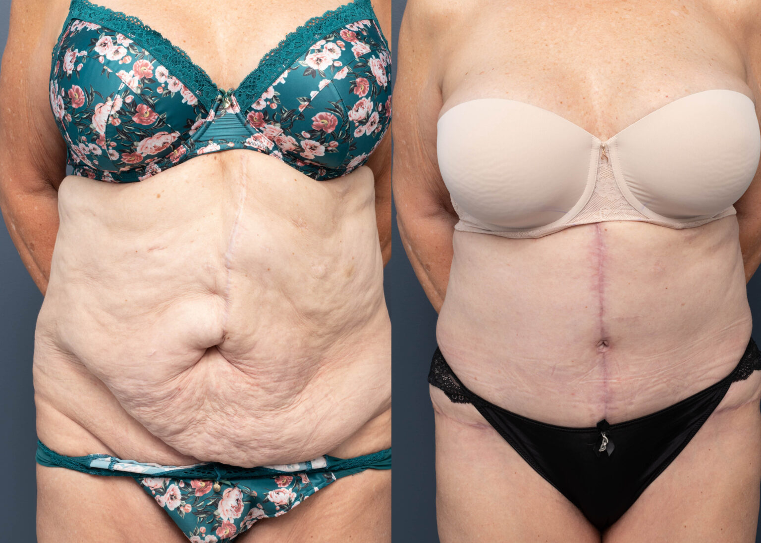 ABDOMINOPLASTY