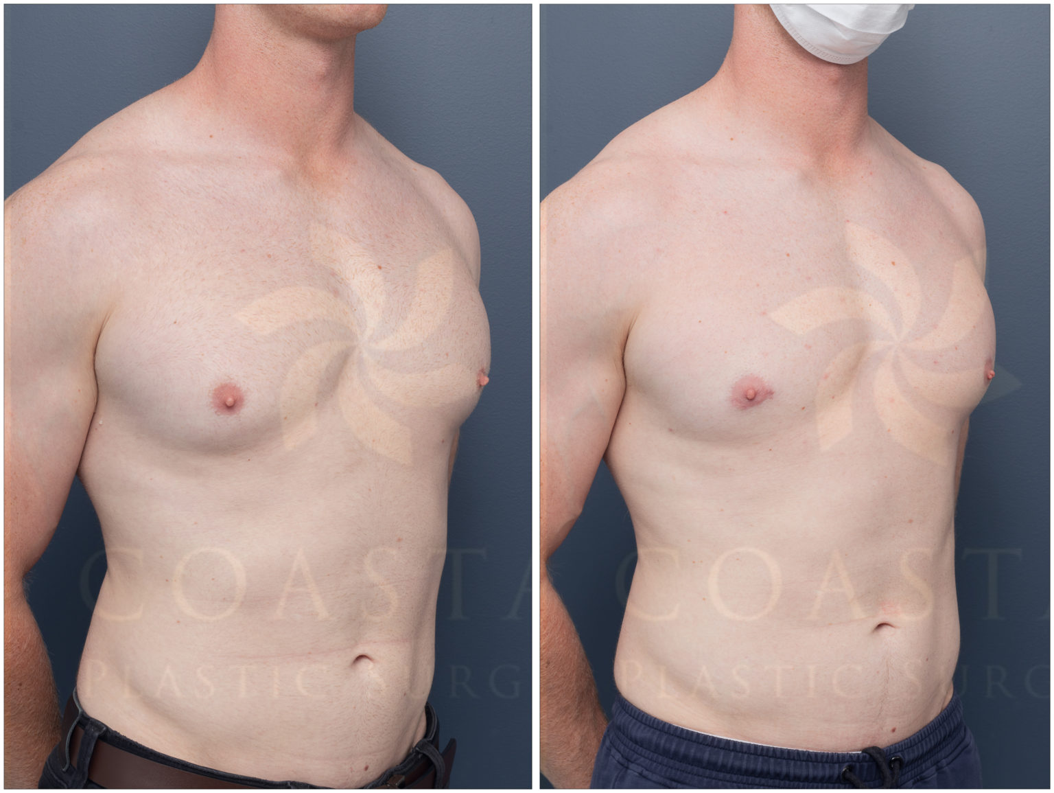 gynaecomastia