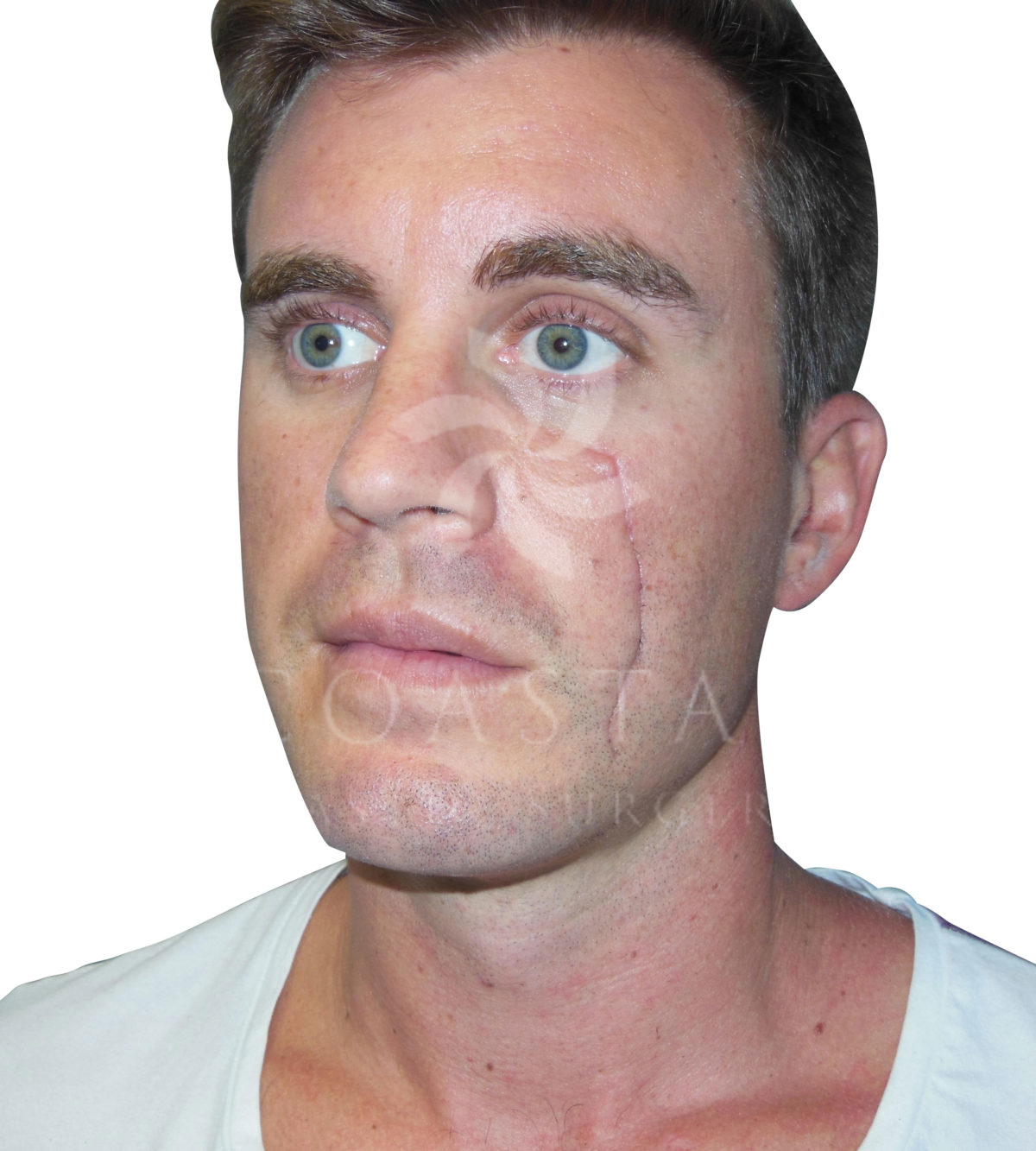 face scar treatments