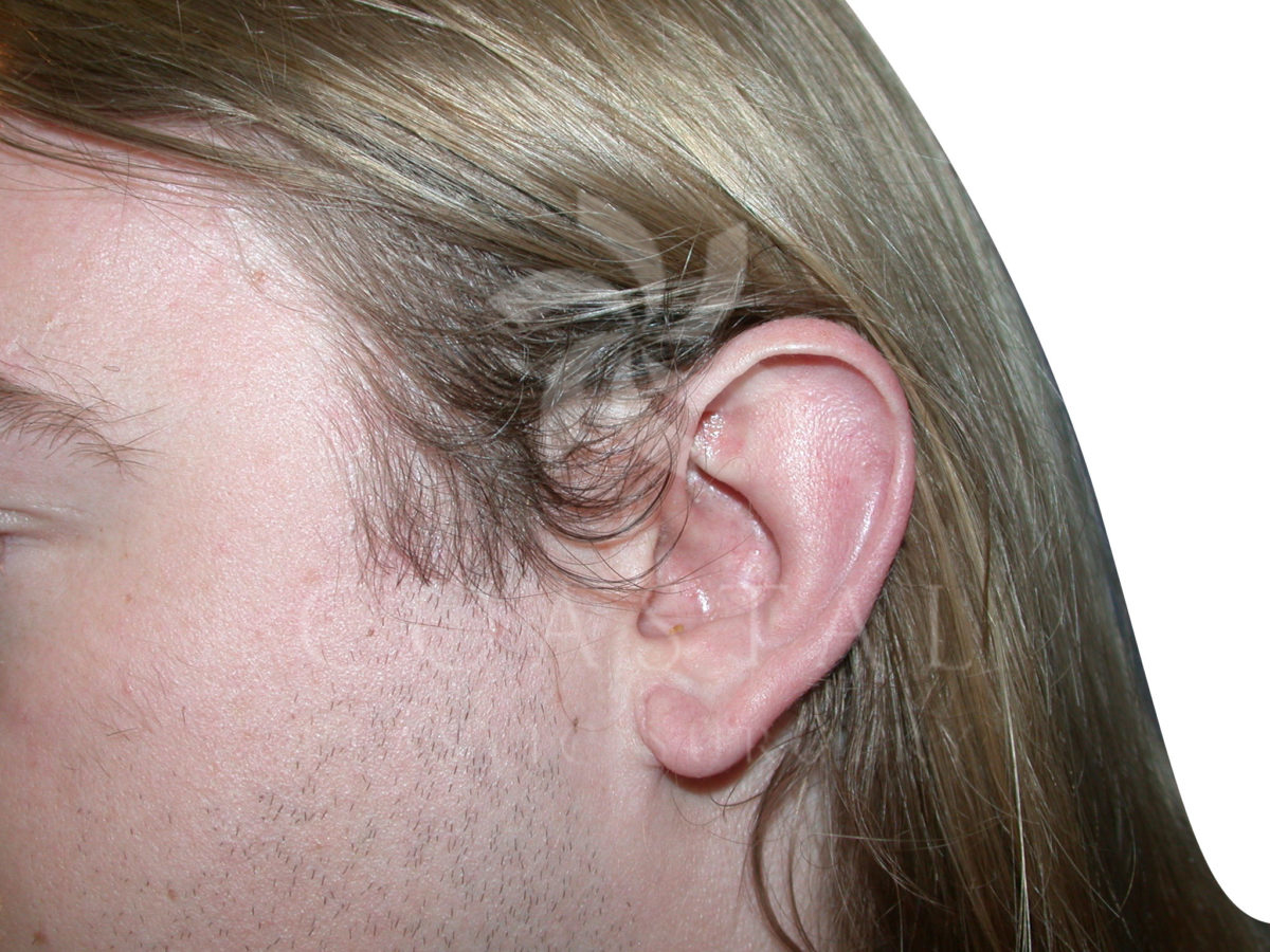 earlobe reconstruction