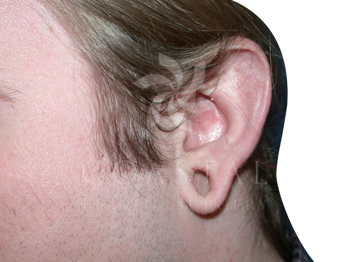 earlobe reconstruction