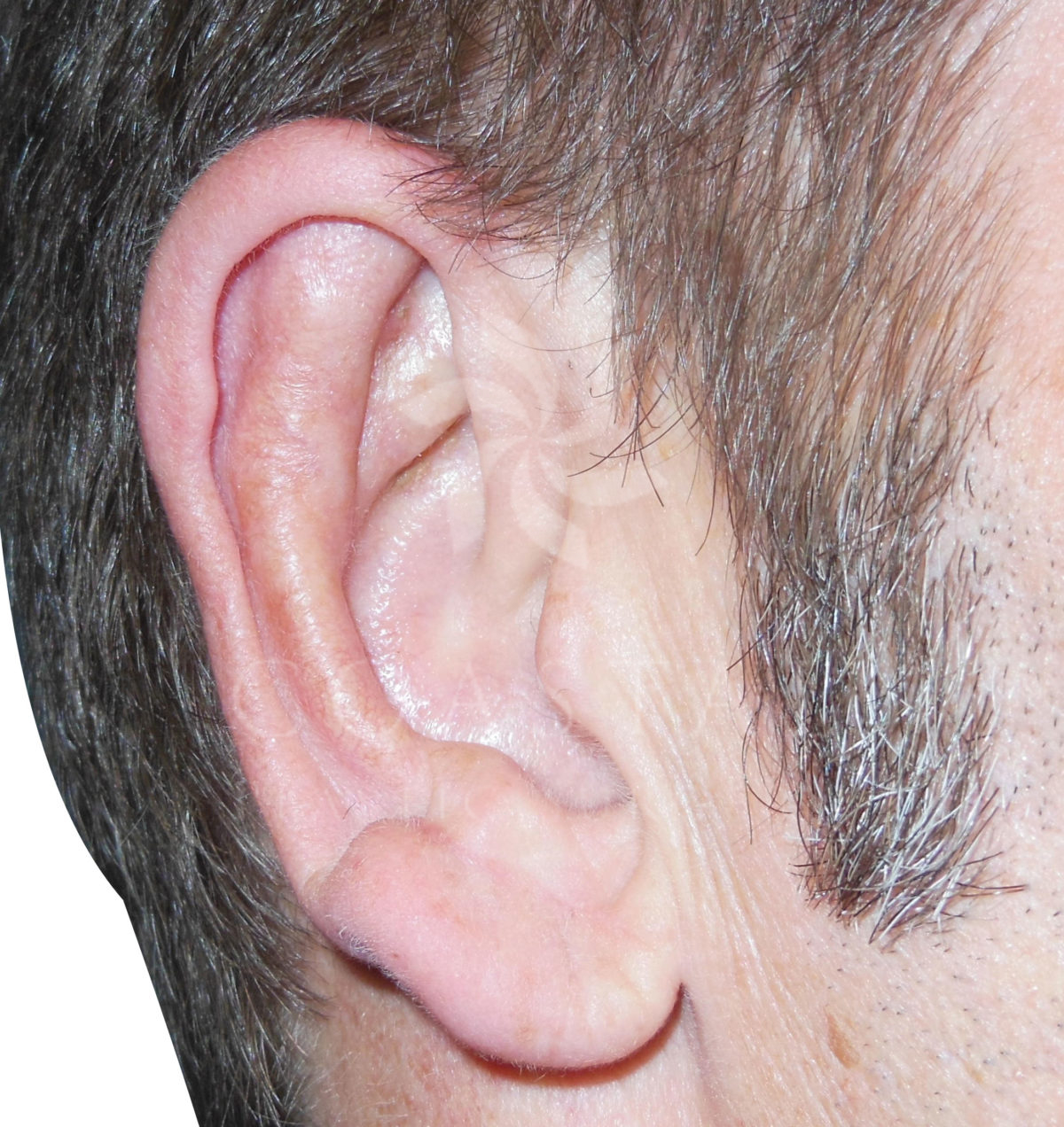 earlobe reduction