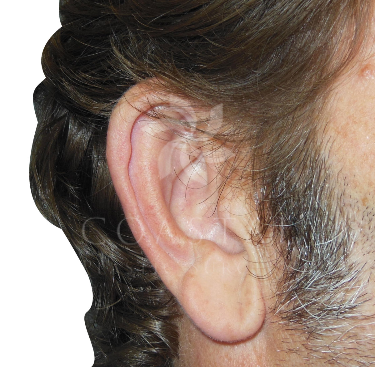 earlobe reduction