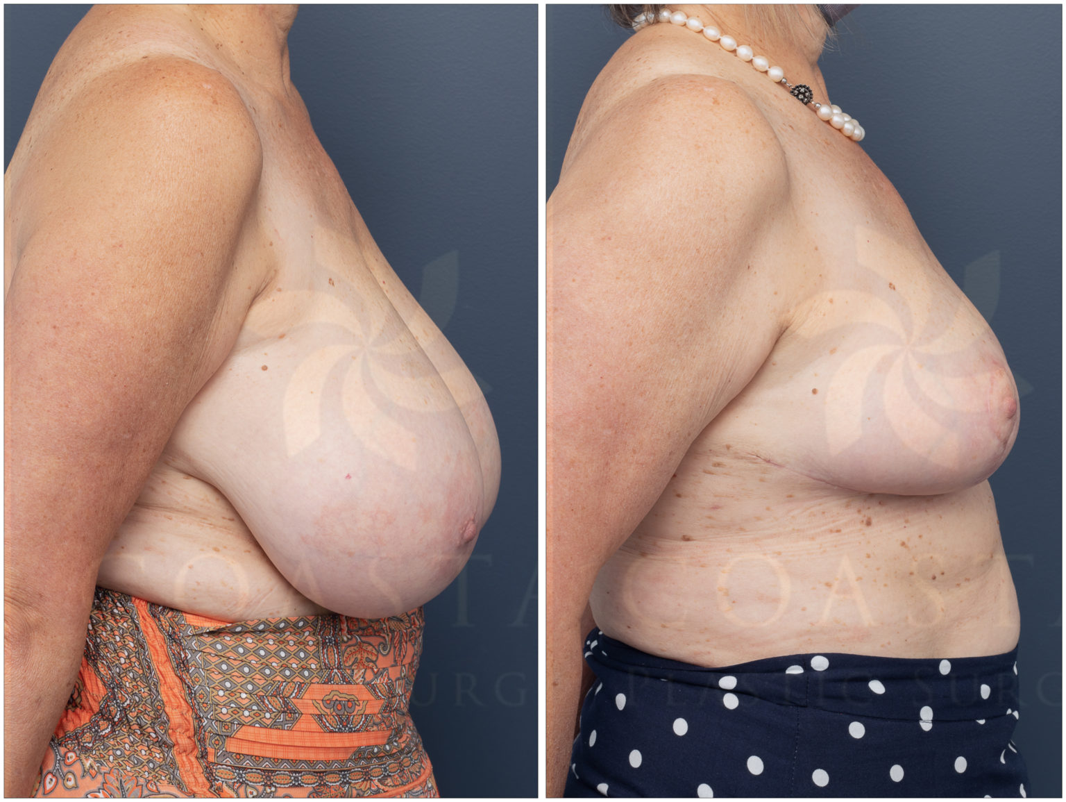 breast reduction