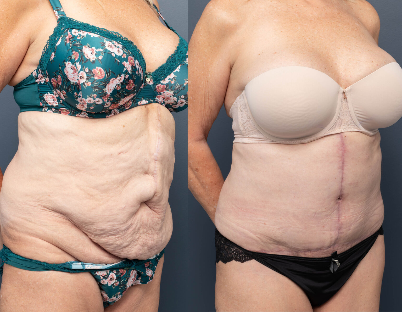 ABDOMINOPLASTY